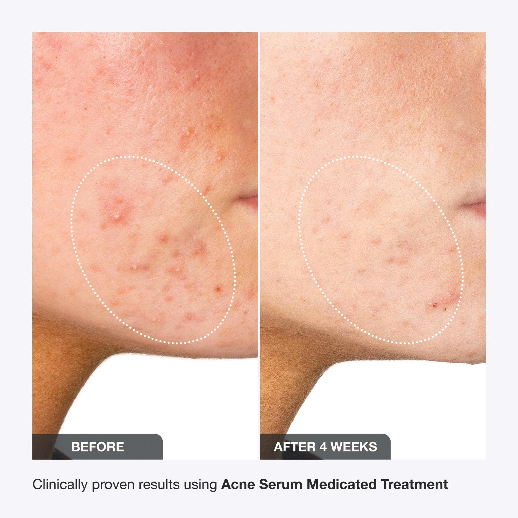 Acne Serum - Image 10